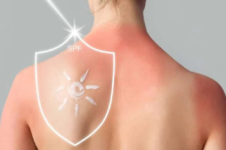 80% случаев меланомы кожи: как УФ-излучение становится главной причиной болезни