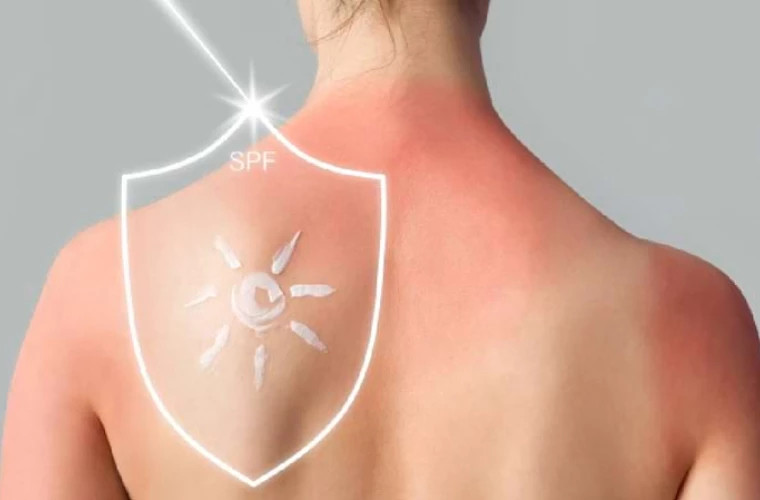 80% случаев меланомы кожи: как УФ-излучение становится главной причиной болезни