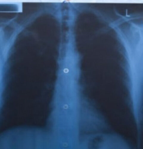 Частота рентгенографии легких: сколько раз безопасно проходить процедуру?