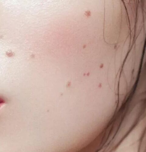 Почему обладатели родинок доживают до глубокой старости?