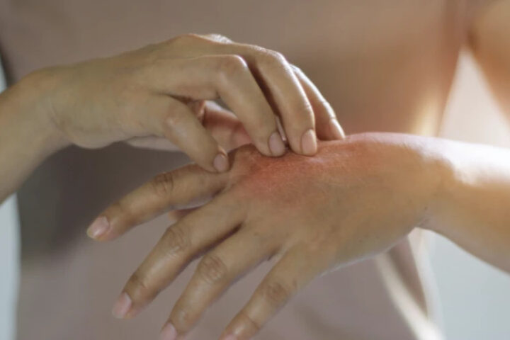 В Румынии подтверждён второй случай проказы у массажистки из Клуж-Напоки