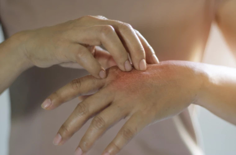 В Румынии подтверждён второй случай проказы у массажистки из Клуж-Напоки