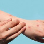 В Молдове подтверждён случай оспы обезьян: пациент под медицинским наблюдением