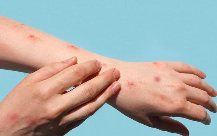 В Молдове подтверждён случай оспы обезьян: пациент под медицинским наблюдением