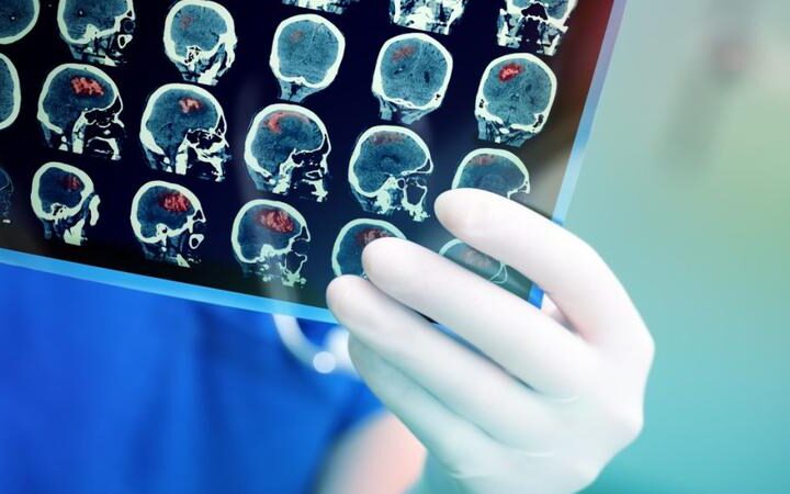 Лечение пациента с инсультом стоит 40 тысяч леев: сколько пациентов получили помощь в 2026 году?